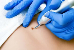 Cryosurgery
