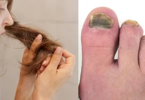 Hair and Nail Disorder