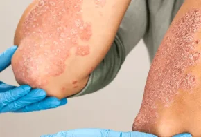 Psoriasis therapy