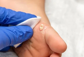 Wart removal