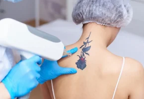 tatto remove